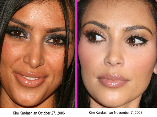 kim kardashian plastic surgery before and after 2010. kim kardashian is not a